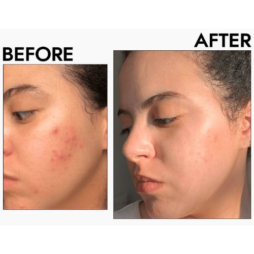 Anti Acne Treatment