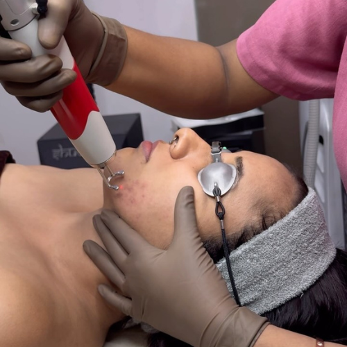 Laser Hair Removal
