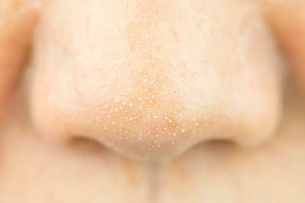 Blackheads