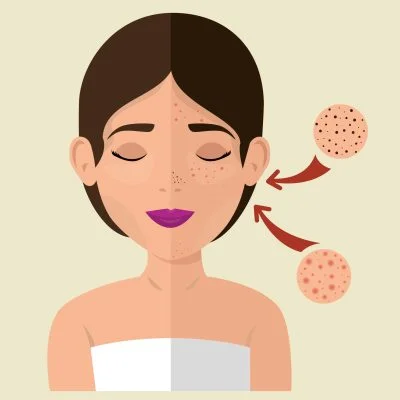 Blackheads