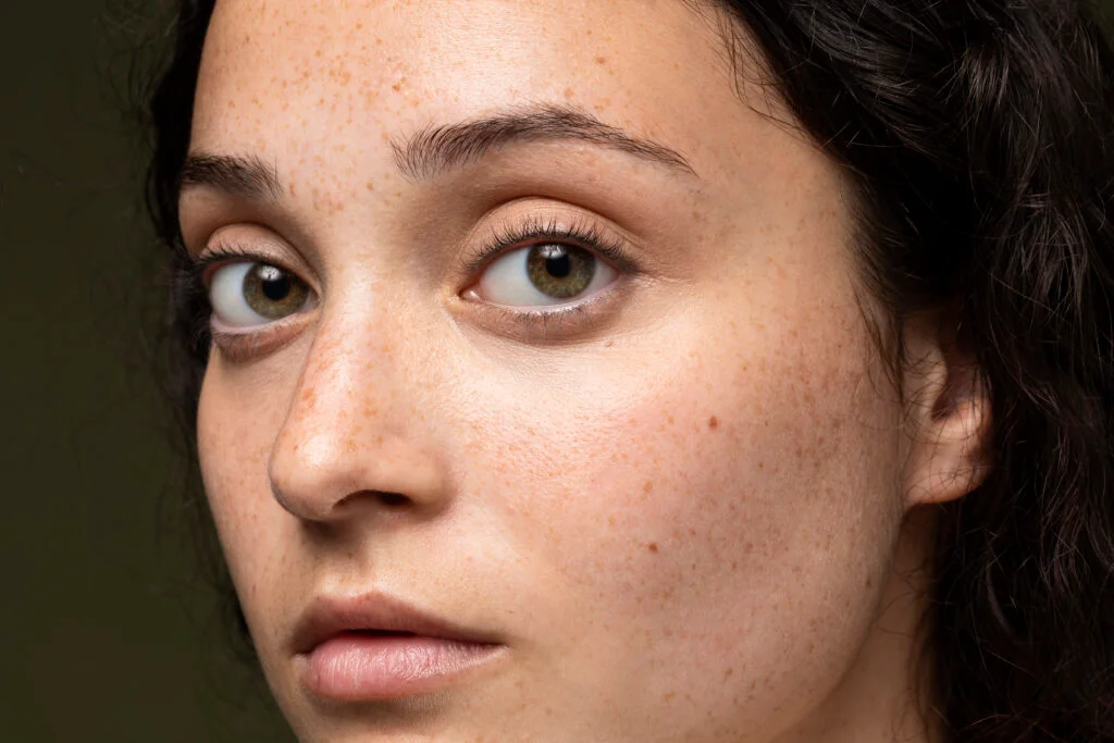 Hyper pigmentation