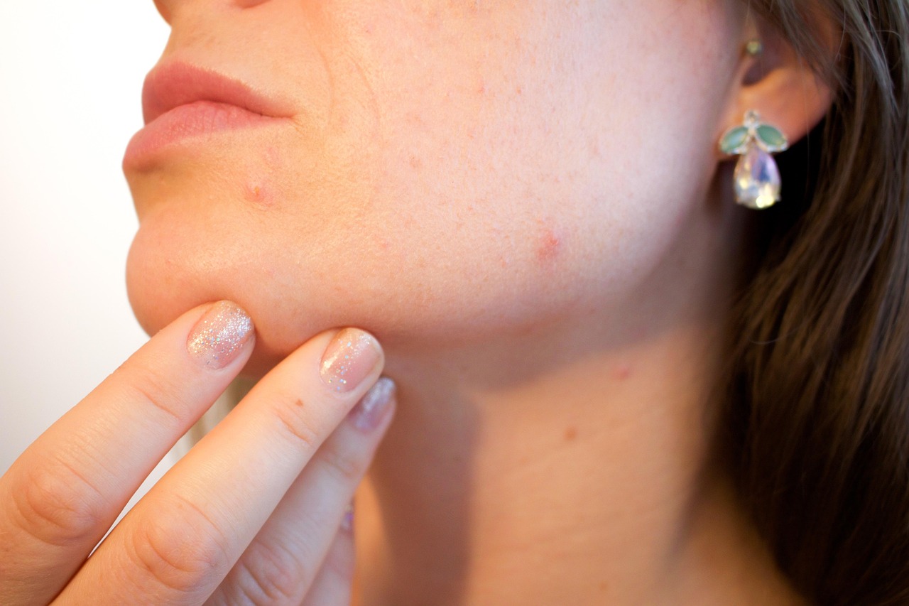 Do’s and Don’ts for Acne Breakouts on the Face