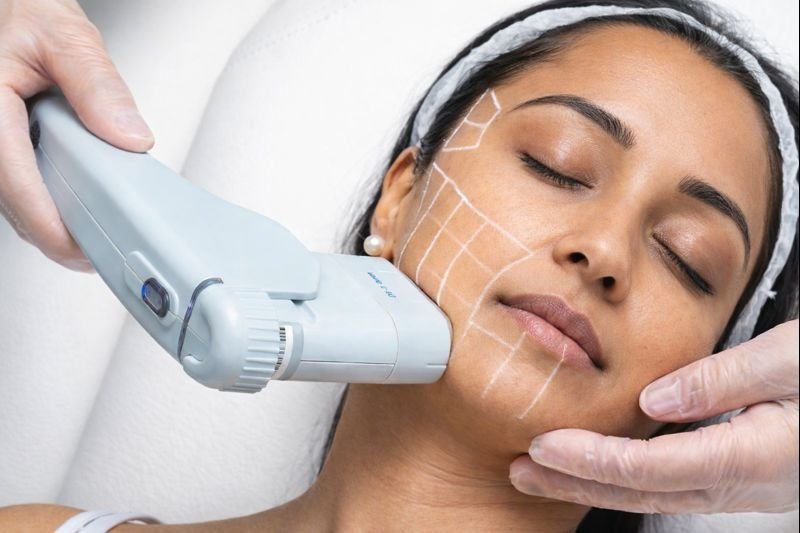 Skin Tightening treatment