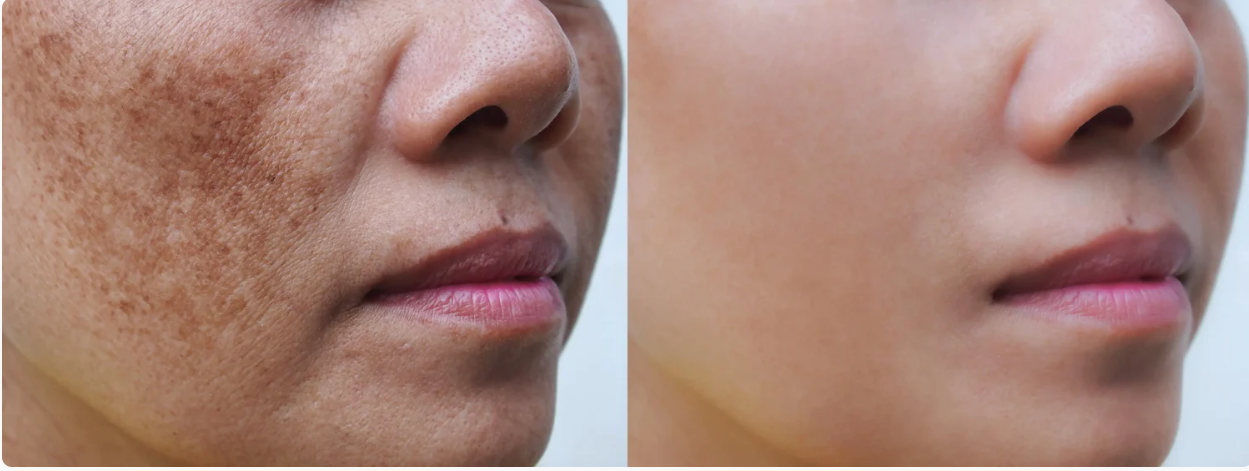 niacinamide