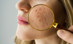 Acne Scar