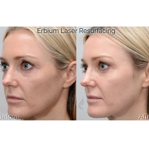 Erbium Yag Laser