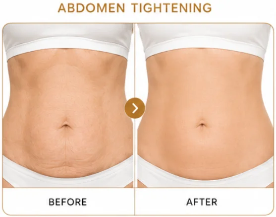 BTL exilis ultra 360