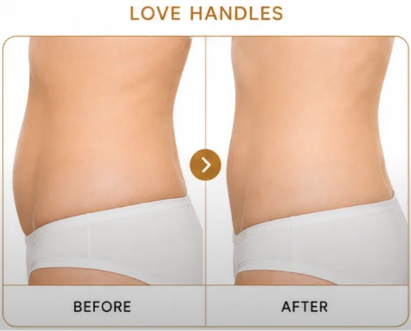 BTL exilis ultra 360