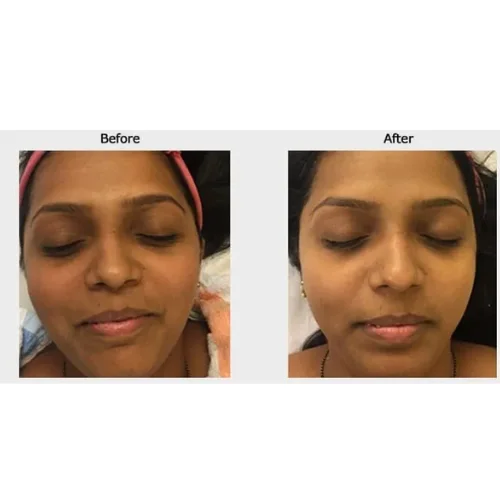Phenol peel