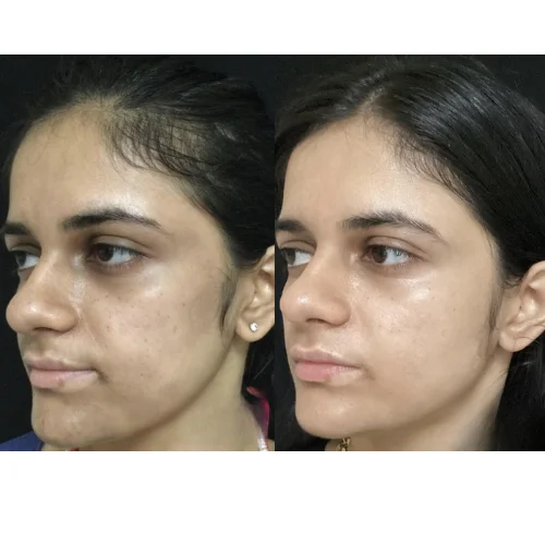 Phenol peel