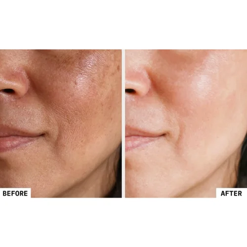 Phenol peel