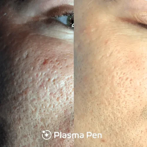 Plasma pen