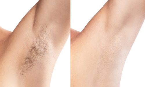 Comparison of female armpit after hair removal Best laser hair removal in Mumbai