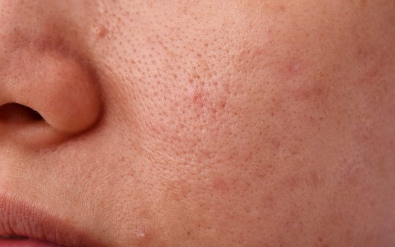 Skin problem with acne diseases, Close up woman face with dry lip mouth, Scar and oily greasy face, Beauty concept.